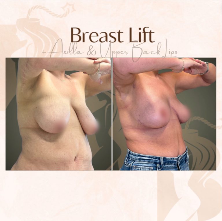 before and after liposuction right angle view female patient case 4002