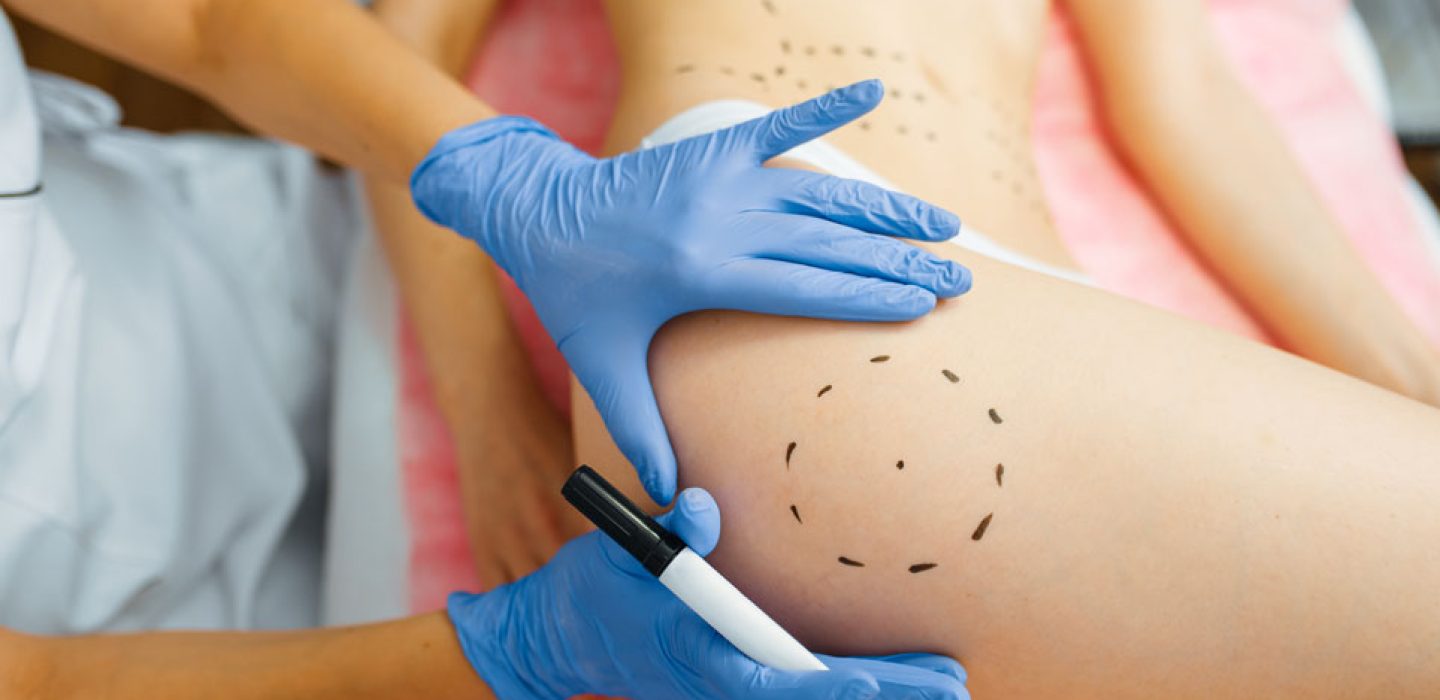 cosmetician-with-marker-puts-dotted-lines-on-body-46BU9A4_2.jpg